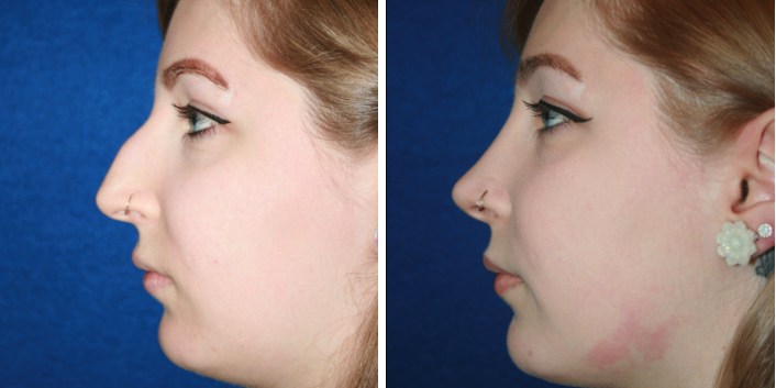 Before & After Rhinoplasty Surgery Toms River NJ | Manasquan