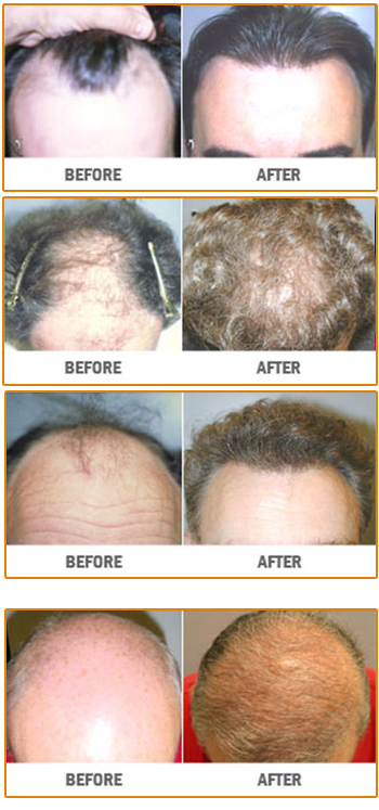 NeoGraft before and after hair transplant