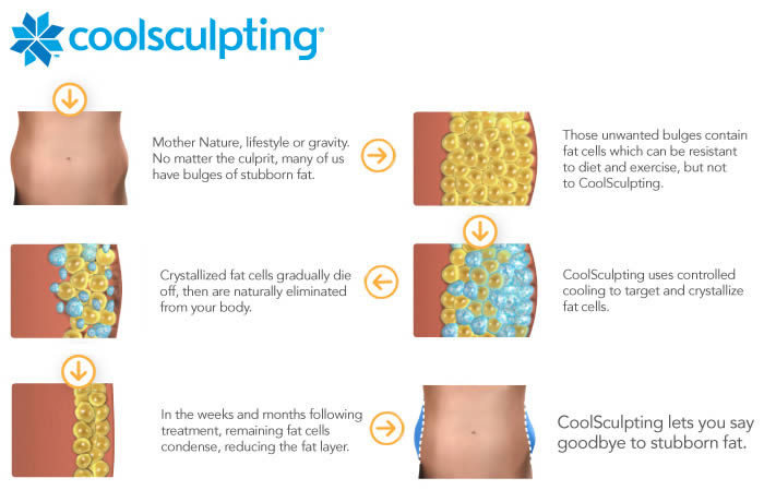 Phoenix Coolsculpting