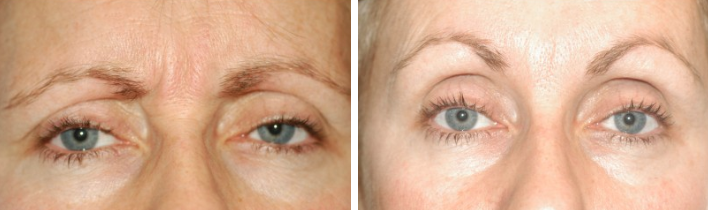 before and after Botox Manasquan NJ