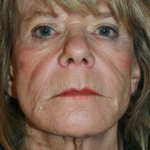 Before Facelift Toms River NJ