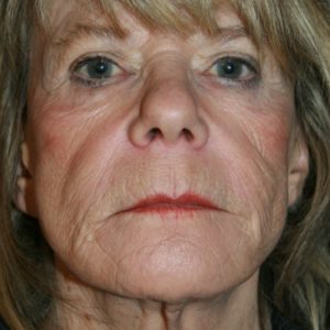 Facelift Before 1 | Toms River NJ