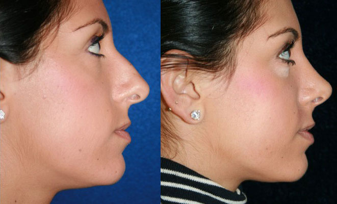 Before and After Revision Rhinoplasty