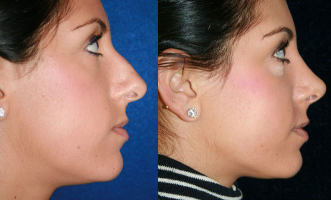 Before and After Revision Rhinoplasty Toms River NJ