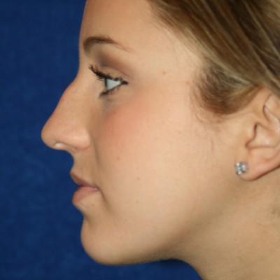 A before image of a young woman that underwent nose surgery by Dr. Foster.