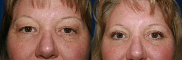 Eyelid Surgery Before and After Toms River NJ