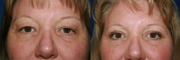 Blepharoplasty Surgery NJ Before and After Toms River NJ