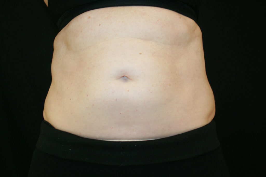 CoolSculpting (fat reduction) Before and After Toms River NJ | Manasquan NJ