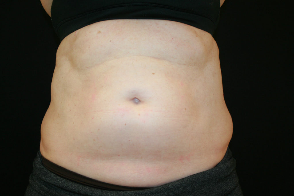 CoolSculpting (fat reduction) Before and After Toms River NJ | Manasquan NJ