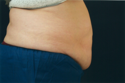 CoolSculpting (fat reduction) Before and After Toms River NJ | Manasquan NJ