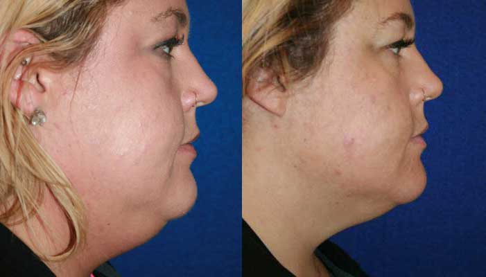 Kybella Before and After Toms River NJ