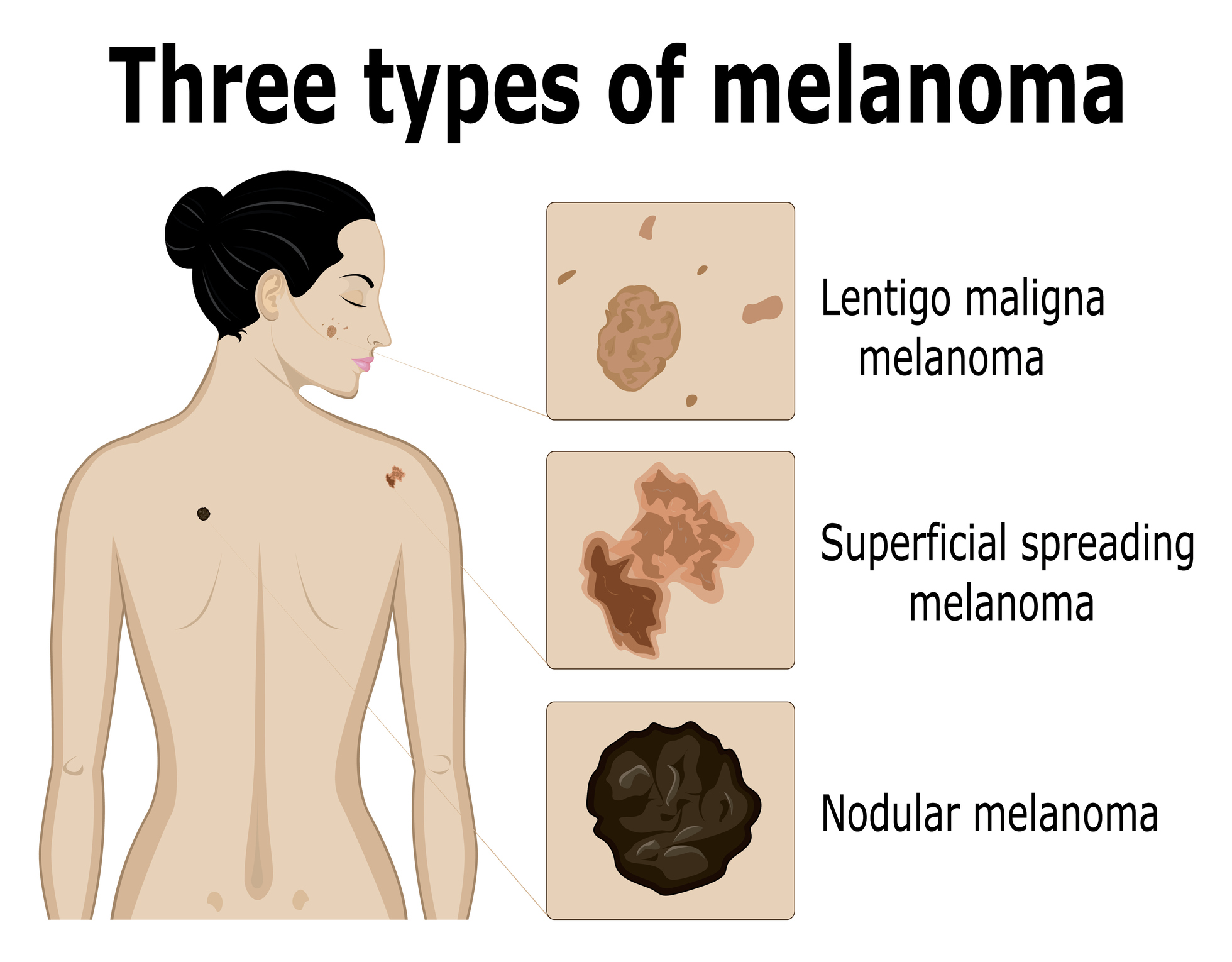 The 3 types of Melanoma