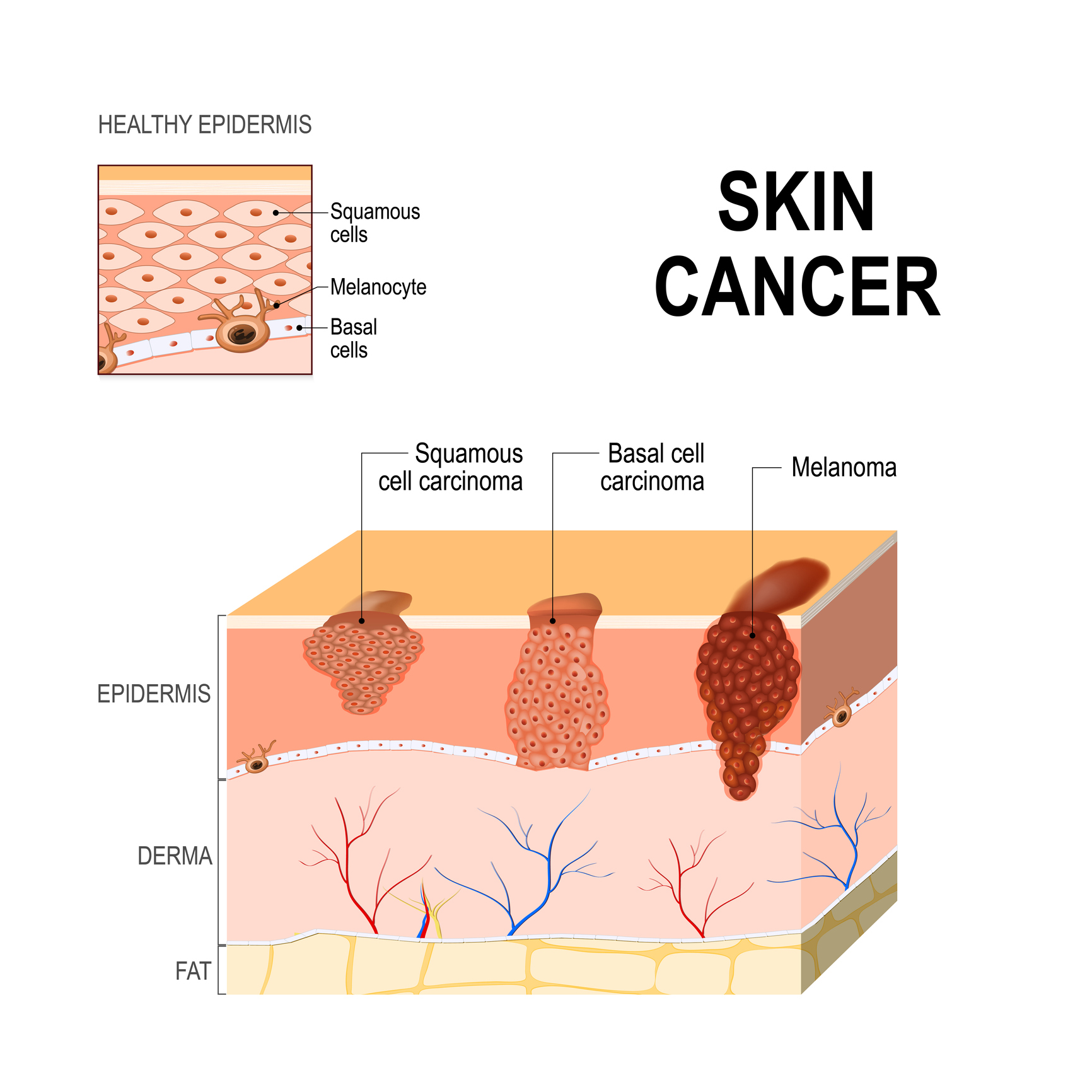 Stages of Skin Cancer and Melanoma 