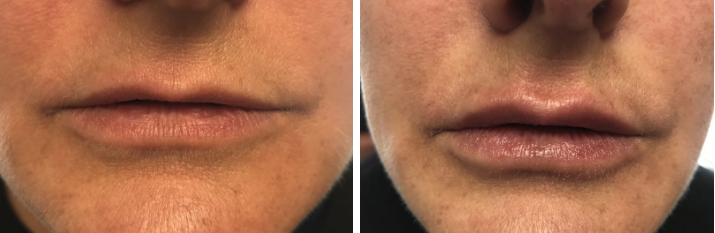 before and after Lip Injections Manasquan NJ