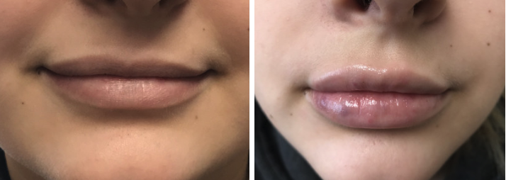 Close up of woman's mouth showing before and after of lip injection