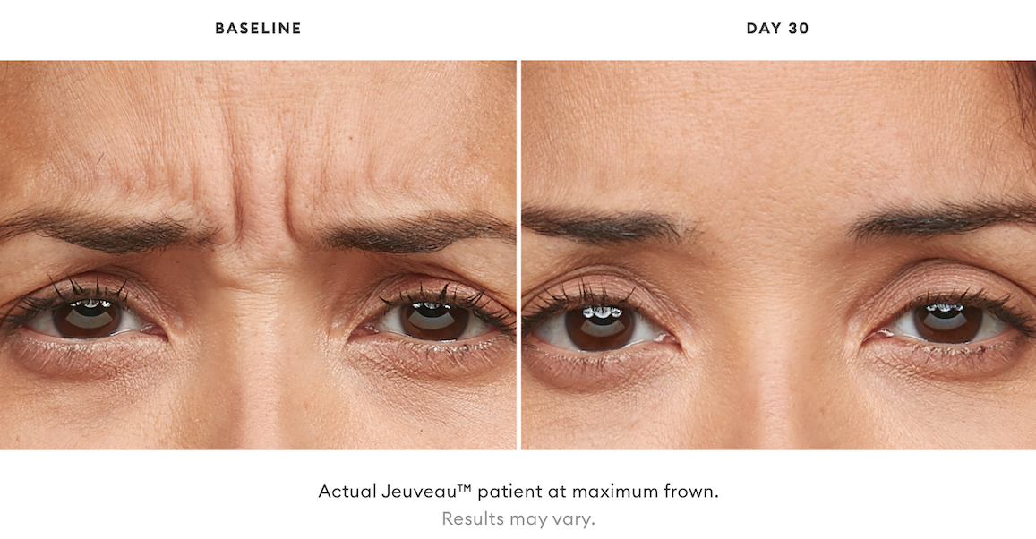 Jeuveau™ Toms River, NJ
