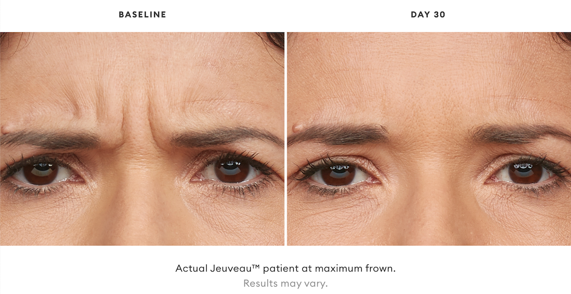 Jeuveau™ Toms River, NJ