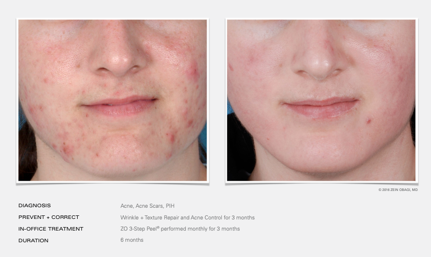Before and After Image of ZO® Skin Health Manasquan NJ