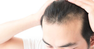 Hair Transplant Toms River NJ